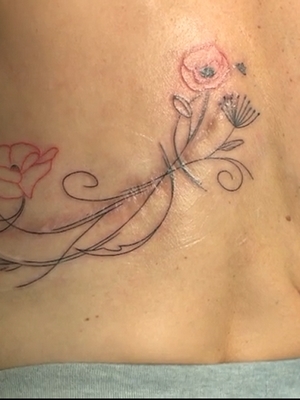 Des tatouages pour effacer les stigmates du cancer