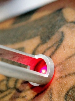VIDEOS. Comment enlever un tatouage ?